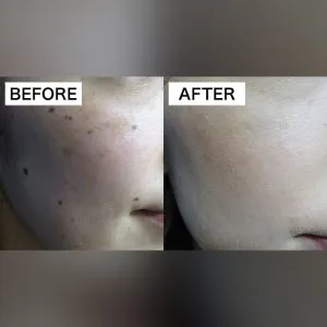 TCBのほくろ除去の症例