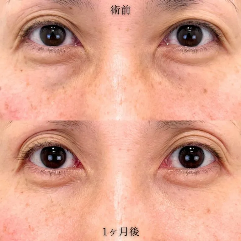 TCBのクマ取りの症例