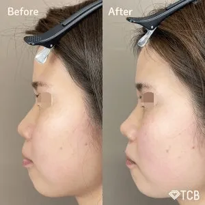 TCBの鼻尖形成の症例