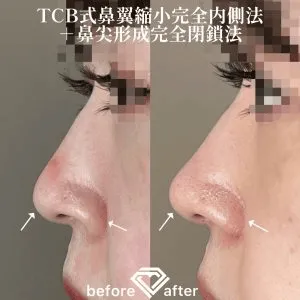 TCBの鼻尖形成の症例