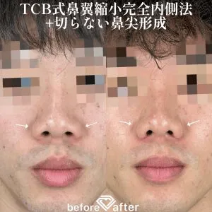 TCBの鼻尖形成の症例