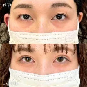TCBの二重埋没の症例