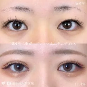 TCBの二重埋没の症例
