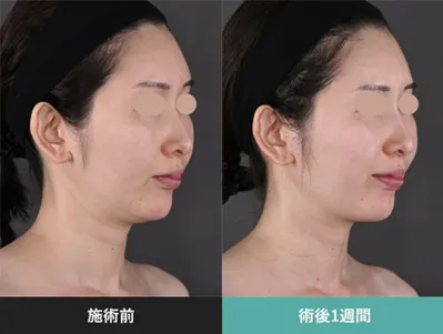 SBCのモフィウス8の症例