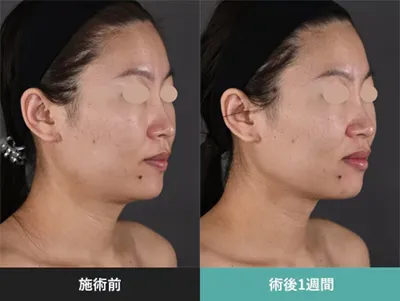 SBCのモフィウス8の症例