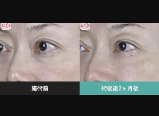 SBCのモフィウス8の症例