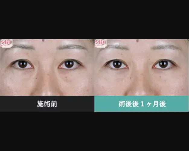 SBCのモフィウス8の症例