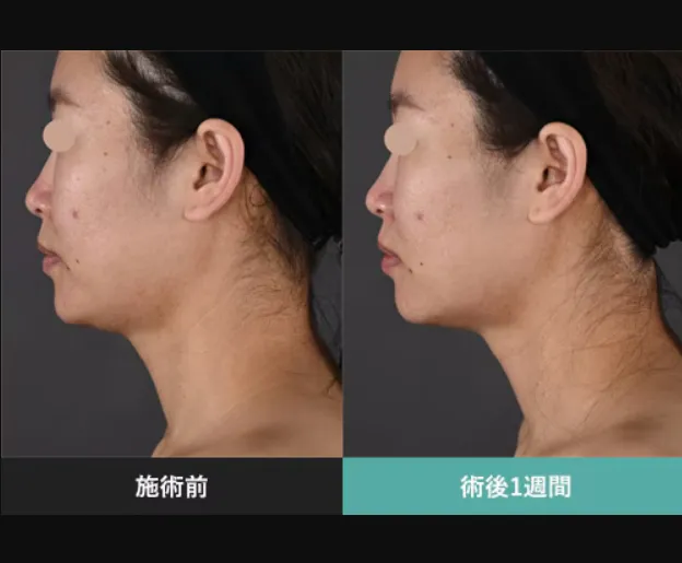 SBCのモフィウス8の症例