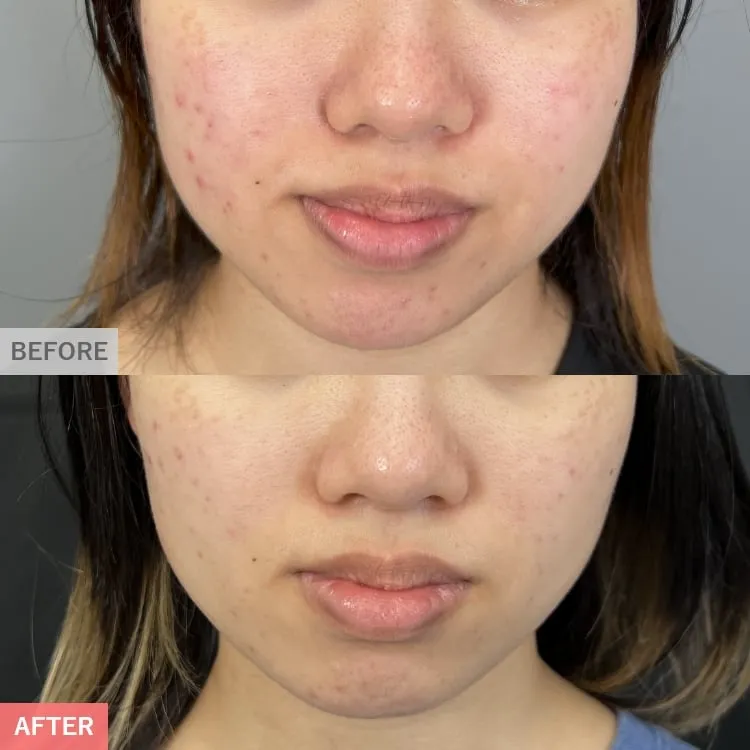 TCBのピコレーザーの症例