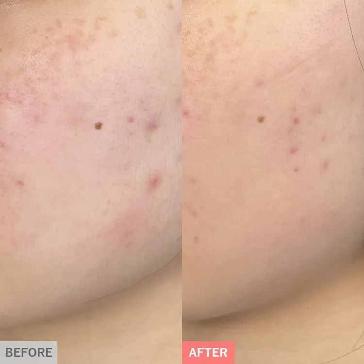 TCBのピコレーザーの症例