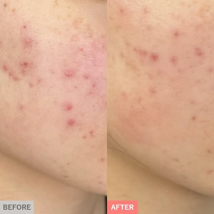 TCBのピコレーザーの症例