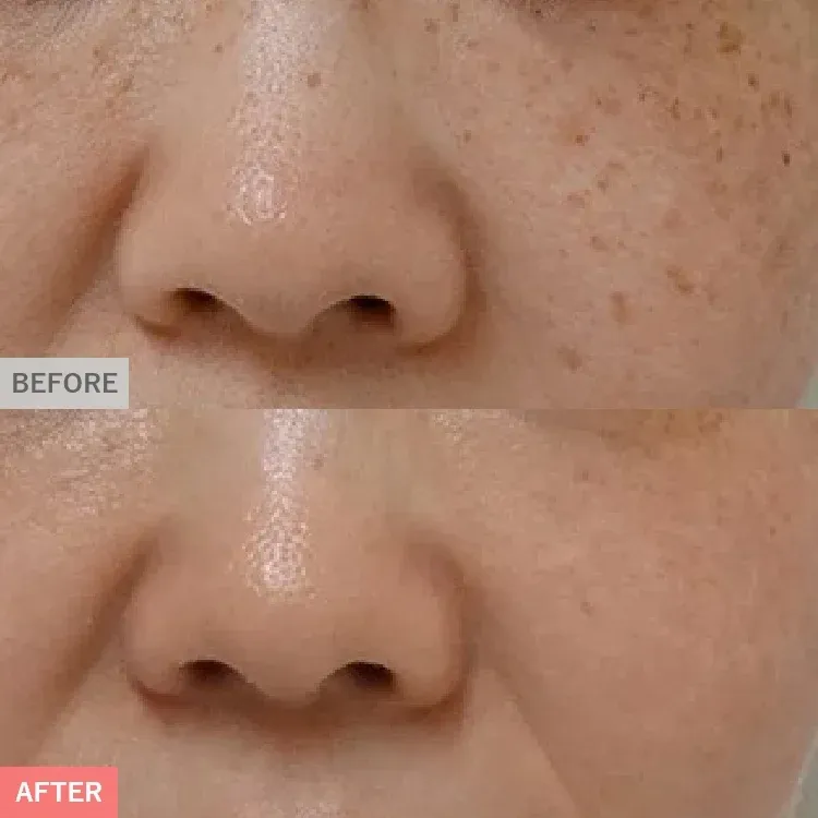 シミ取りの症例写真