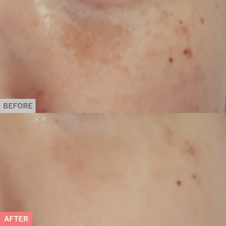 TCBのピコレーザーの症例