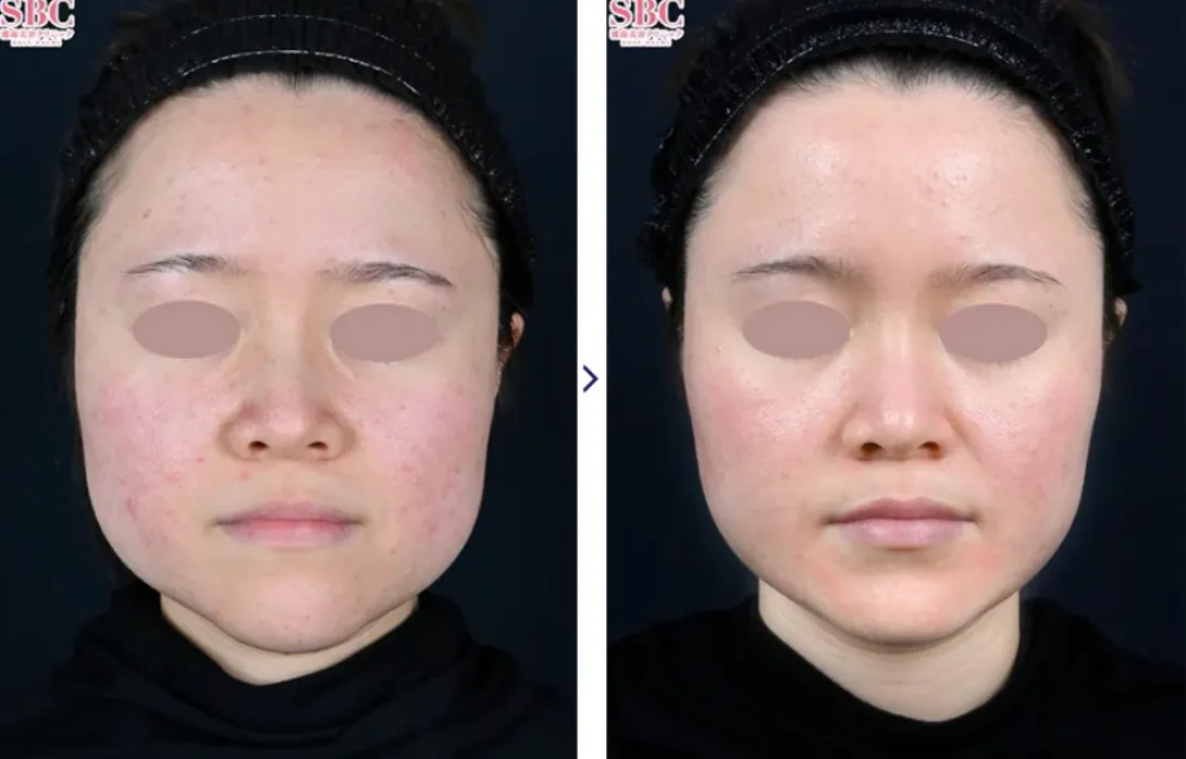 症例② 施術前後