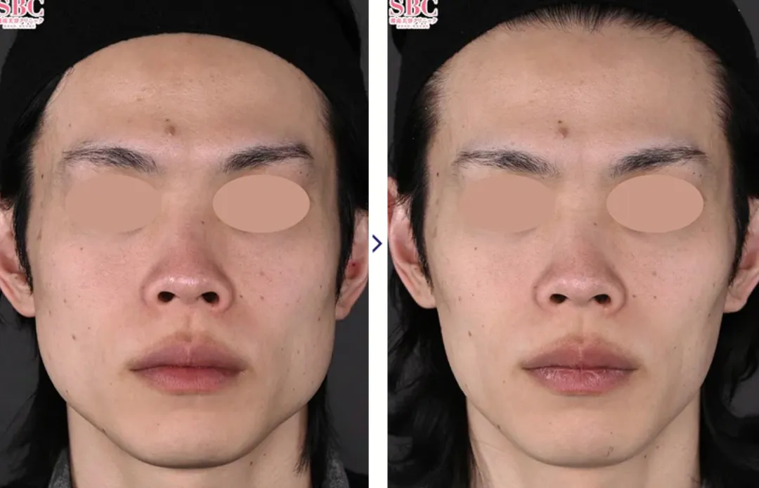 症例① 施術前後