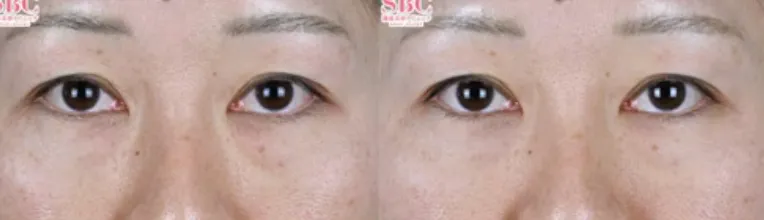 湘南美容クリニック モフィウス8 症例写真 施術前と施術後1週間の比較