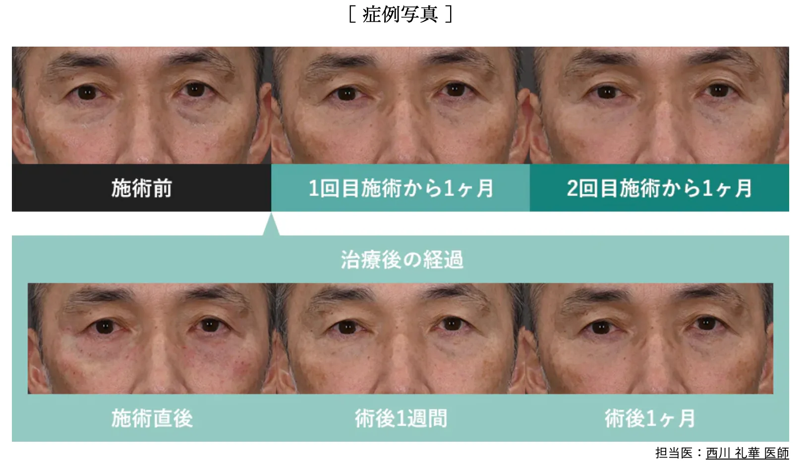 モフィウス8がおすすめの湘南美容クリニックの症例写真
