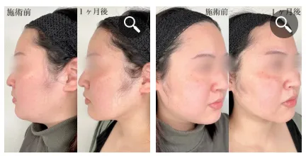 TCBの脂肪溶解注射は何ccで顔痩せできるのか実際の症例写真