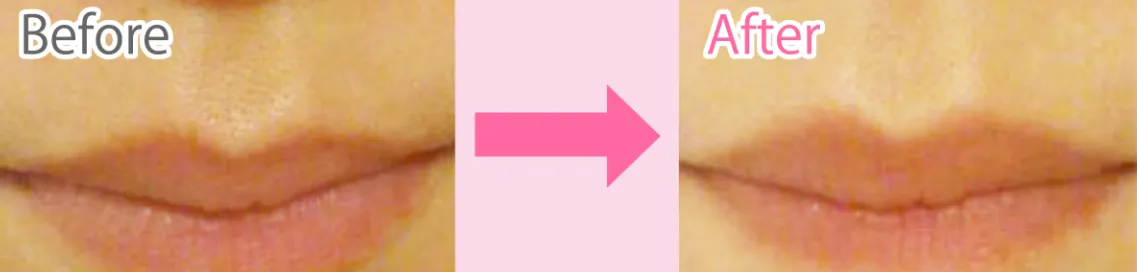エステティックTBC　顔脱毛症例写真