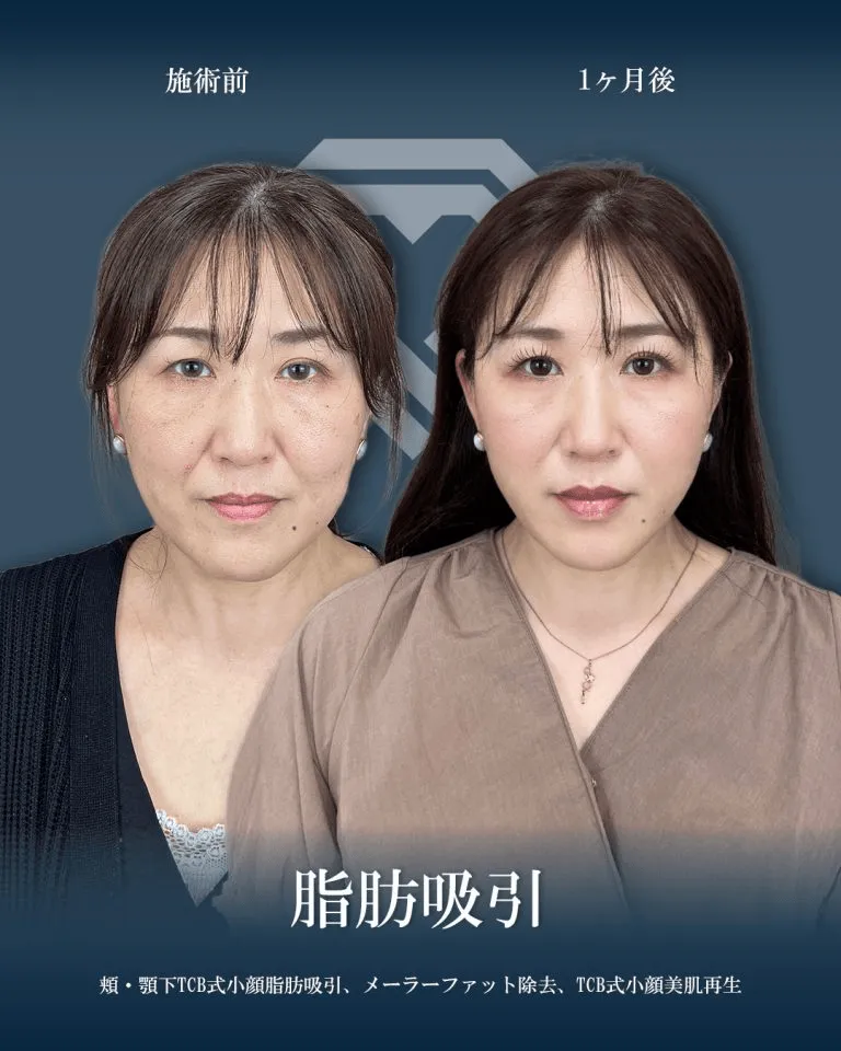 TCBの顔の脂肪吸引の症例