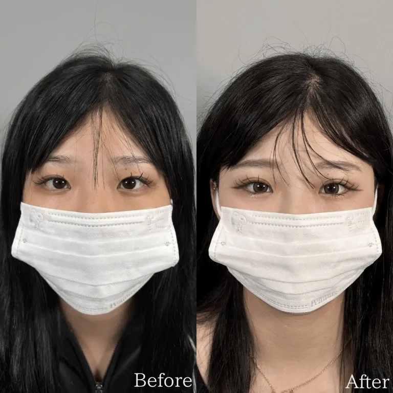 TCBの二重埋没の症例