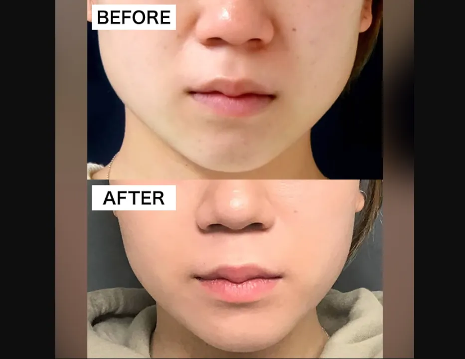 TCBの脂肪溶解注射の症例