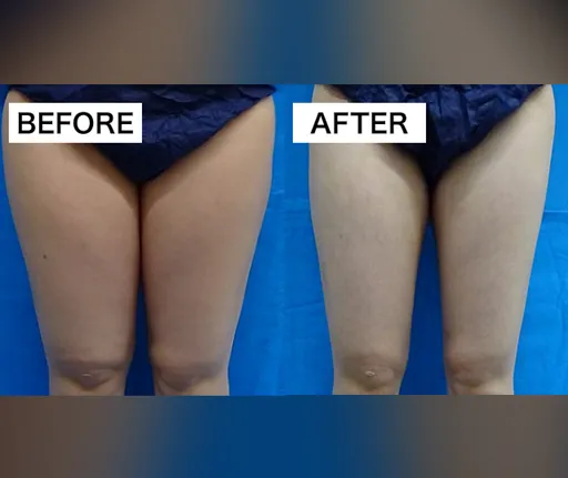 TCBの脂肪溶解注射の症例