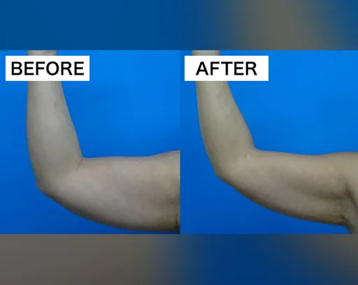 TCBの脂肪溶解注射の症例