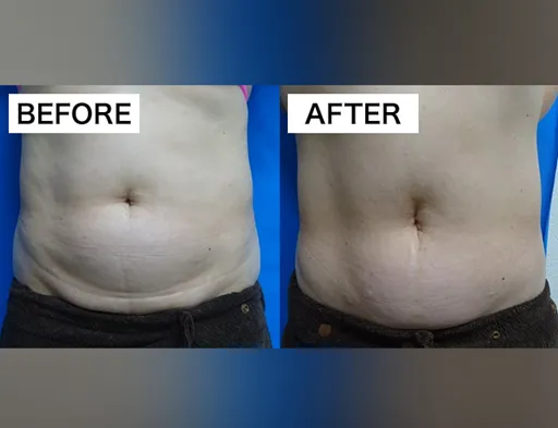 TCBの脂肪溶解注射の症例