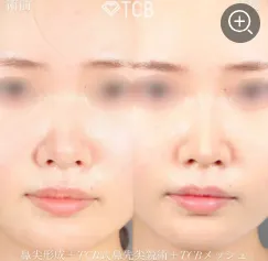 TCBメッシュの鼻整形50,800円(税込)~の症例