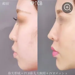 TCBメッシュの鼻整形50,800円(税込)~の症例