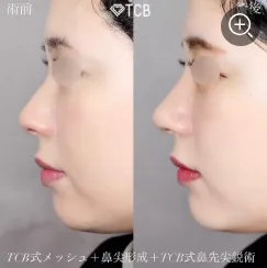 TCBメッシュの鼻整形50,800円(税込)~の症例