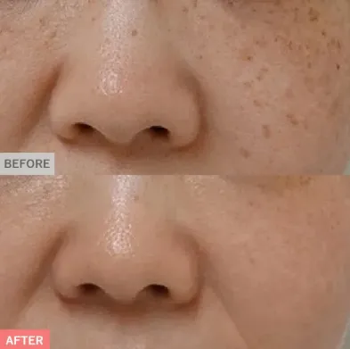 TCBのピコレーザー6,600円～590,800円の症例