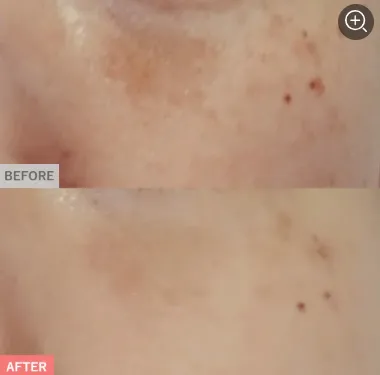 TCBのピコレーザー6,600円～590,800円の症例