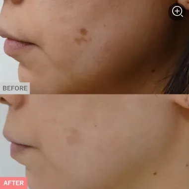 TCBのピコレーザー6,600円～590,800円の症例