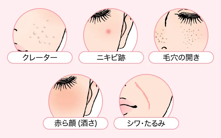 TCBのクーポン利用で料金(値段)が80000円になるポテンツァで効果が期待できる肌トラブル
