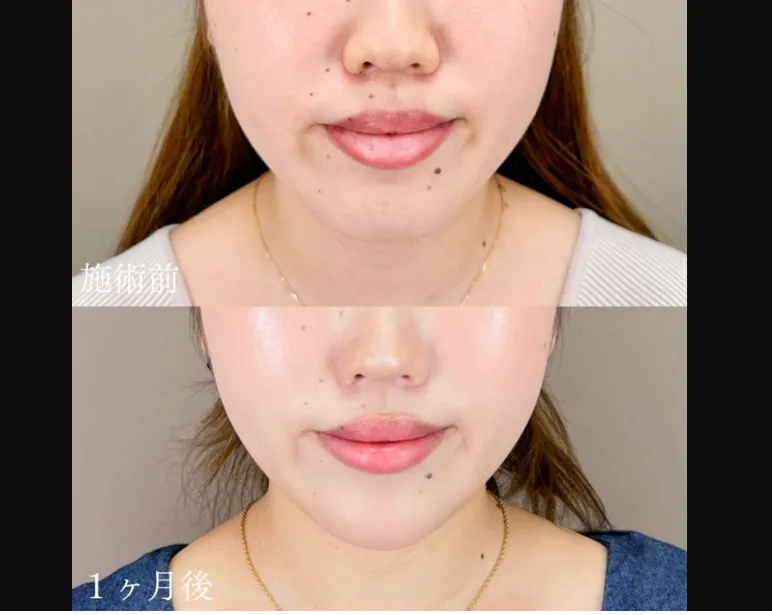 TCBの糸リフトの症例