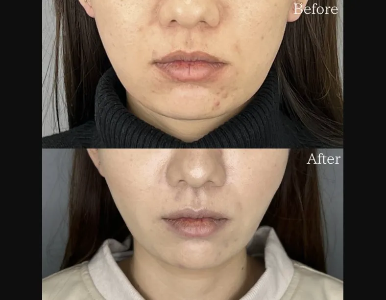 TCBの糸リフトの症例