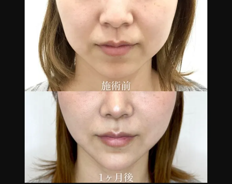 TCBの糸リフトの症例