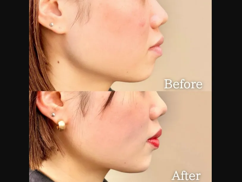 TCBの糸リフトの症例