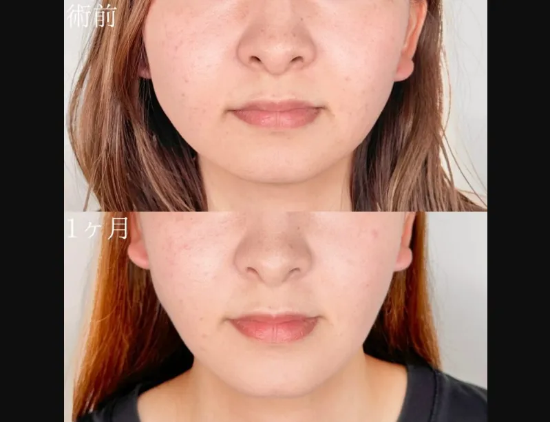 TCBの糸リフトの症例