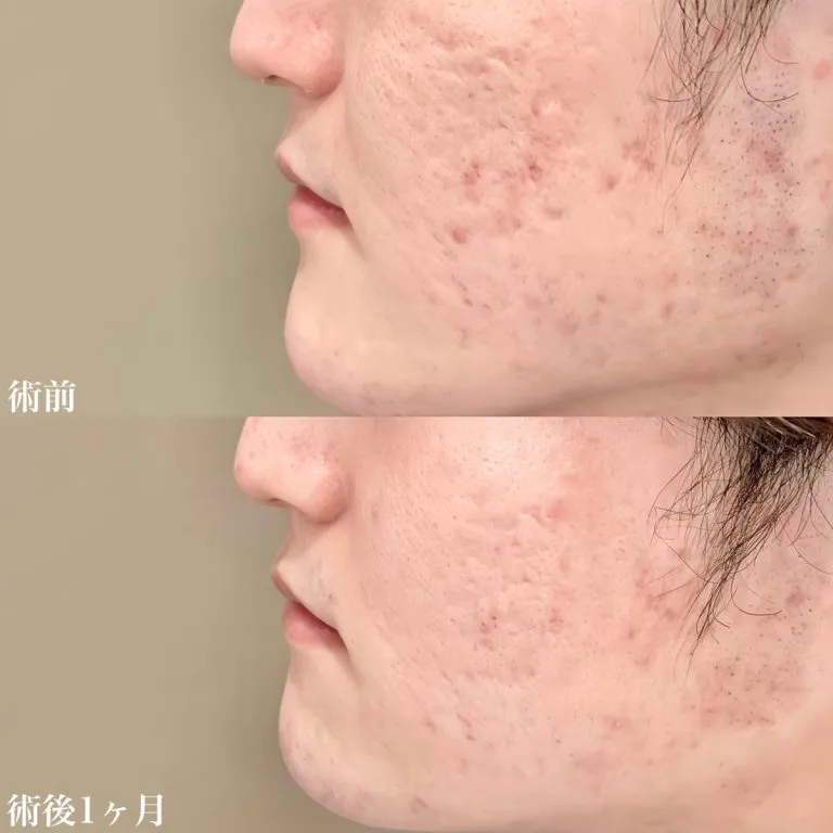 TCBのサブシジョンの症例