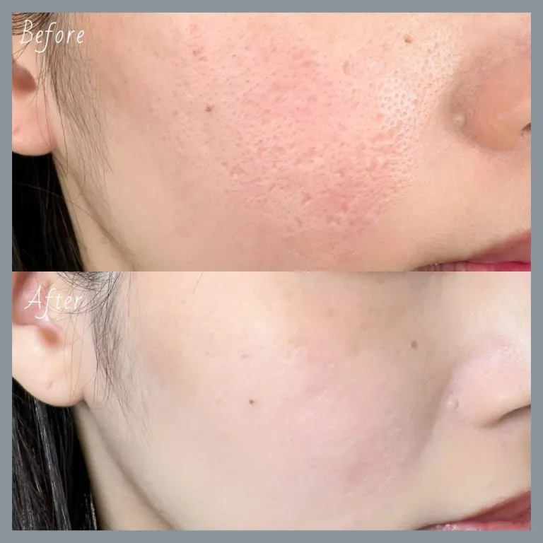 TCBのサブシジョンの症例