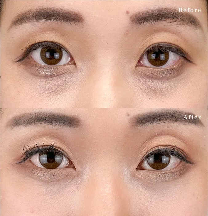 TCBのクマ取りの症例