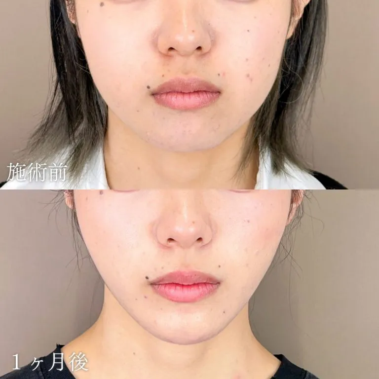 TCBの脂肪吸引の症例