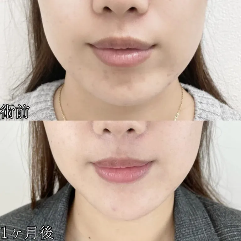 TCBのフェイスリフトの症例