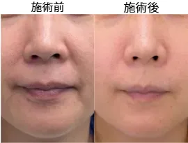 湘南美容クリニックのヒアルロン酸注入の症例