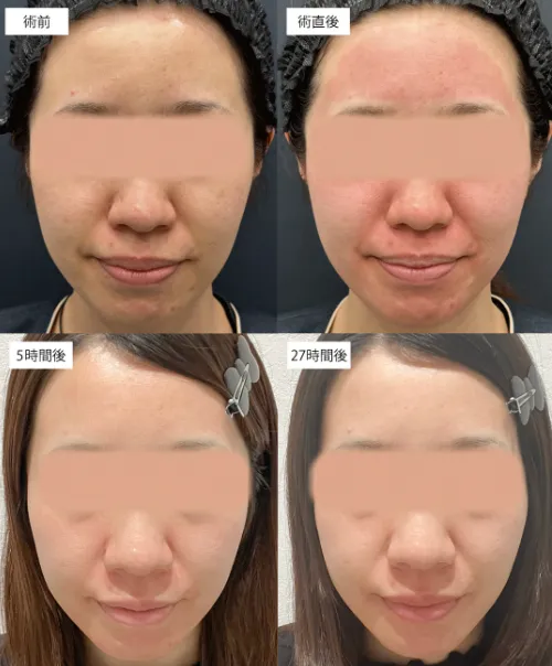 口コミ評価の高い湘南美容クリニックのピコダブルの症例写真②