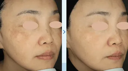 湘南美容クリニックのピコレーザー症例写真