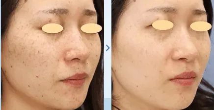 湘南美容クリニックのピコレーザー症例写真